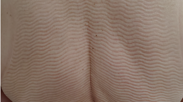 Fibrosis and Lymphedema in the Torso: Treatment Beyond Arms and Legs