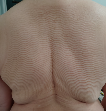 Fibrosis and Lymphedema in the Torso: Treatment Beyond Arms and